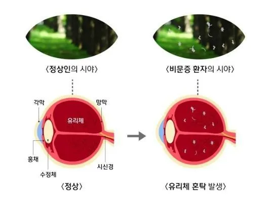 비문증 치료방법