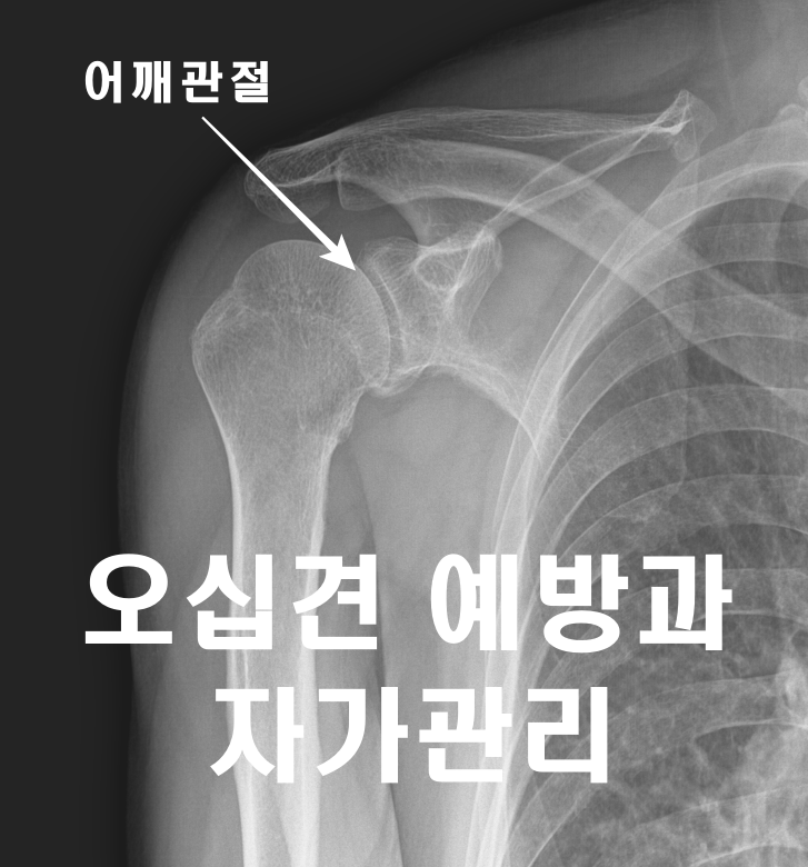  오십견 예방과 자가관리