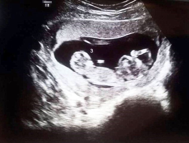 한 부부의 아이를 ‘대리 임신’한 21살 대리모가 초음파 사진 보자 깜짝 놀란 이유