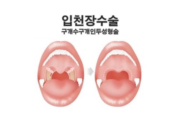 입천장수술