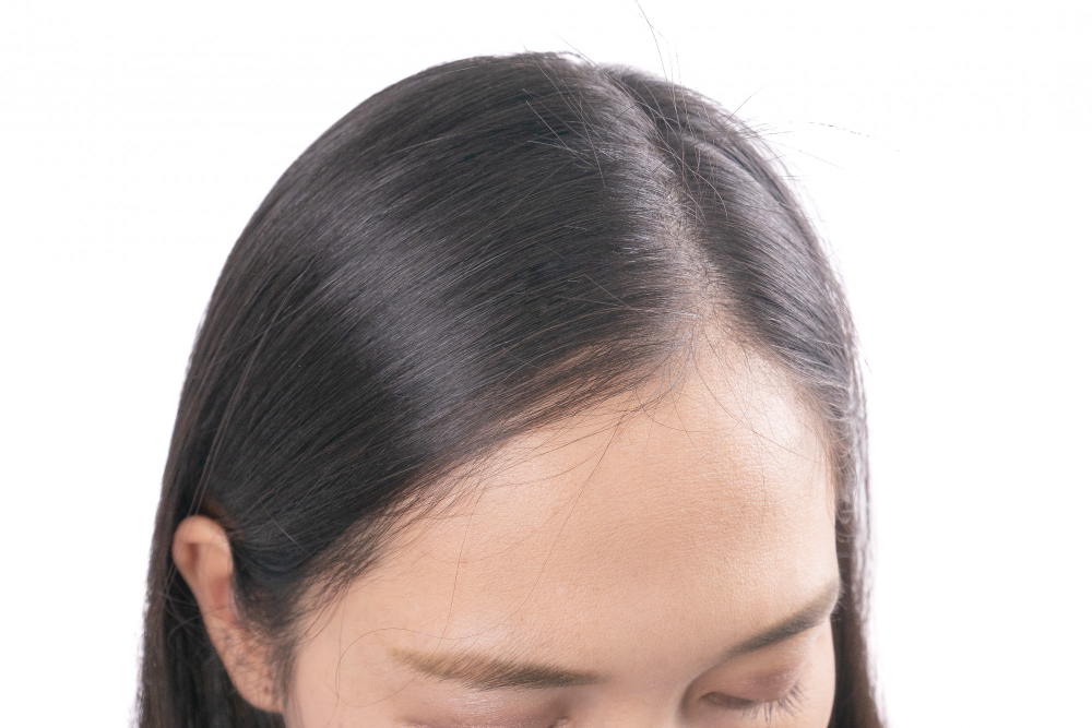 여성 탈모