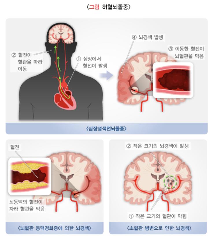 허헐 뇌졸중