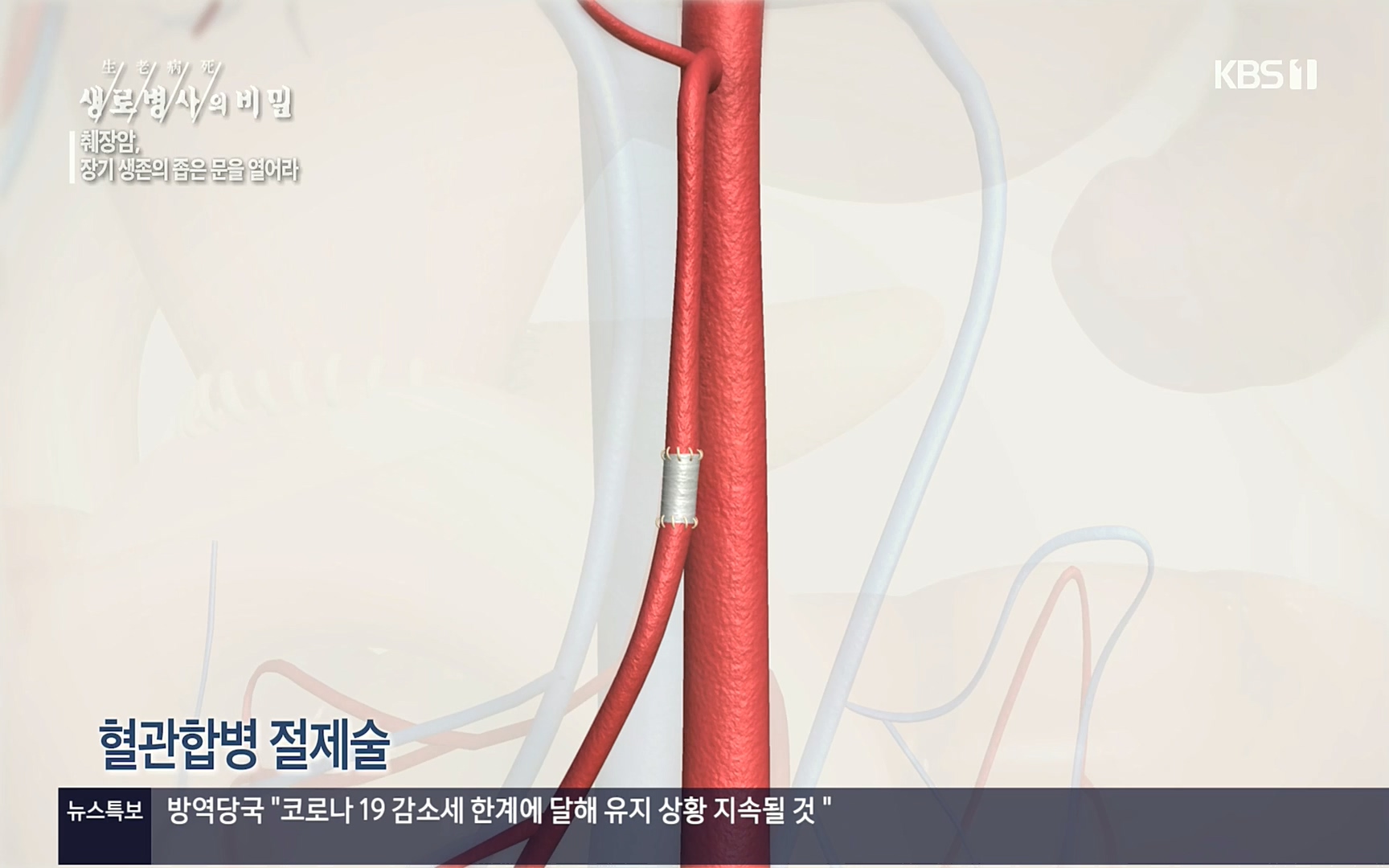 생로병사의 비밀.E823.220622p.H264-F1RST.mp4_20220624_210516.463.jpg