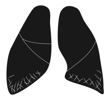 lower lobe fibrotic change