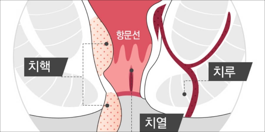 치질의 종류-치핵&#44; 치열&#44; 치루