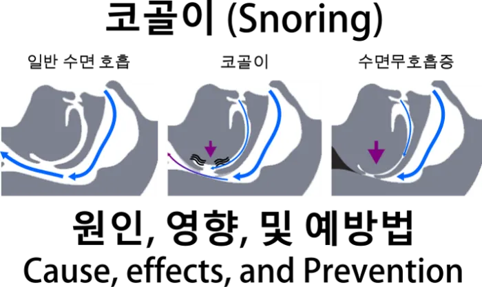 코골이 원인&#44; 영향&#44; 예방법
