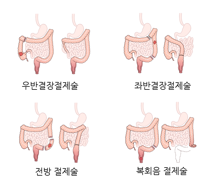대장암의 원인과 증상 및 치료법
