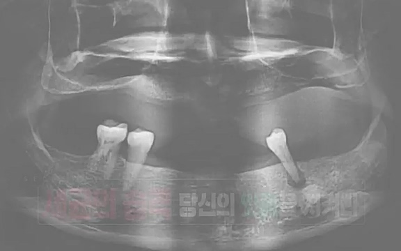 [792회] 생로병사의 비밀 - KBS[세균의 습격, 당신의 잇몸을 지켜라!] 감기보다 병원을 더 자주 찾게 만드는 질병이 있다. 바로 치주질환이다. 2020년 외래 다빈도 질병 1위를 차지한 치은염 및 치주질환 환자는 1,637_20220505_141546.944.jpg