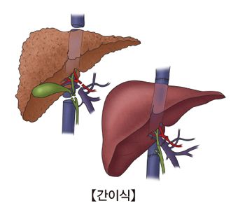 간질환 증세