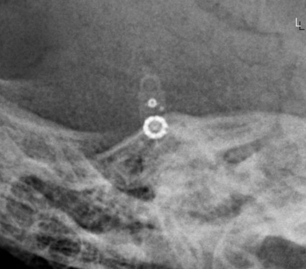 codman&amp;#44; skull x-ray