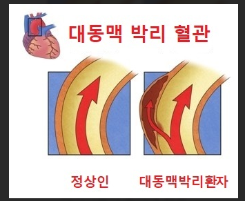정상인과 대동맥박리환자의 혈관을 나타낸 그림