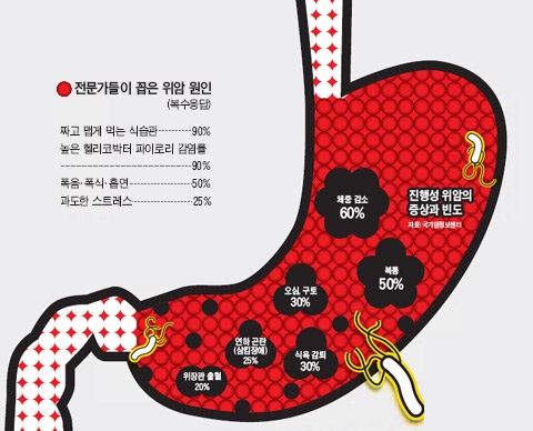  위암의 예후 : 고통 덜고 효과 높인 2차 항암치료법