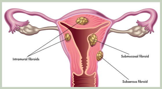 자궁근종 증상