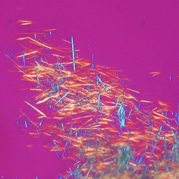 (needle-shaped, birefringent crystal, MSU crystal)