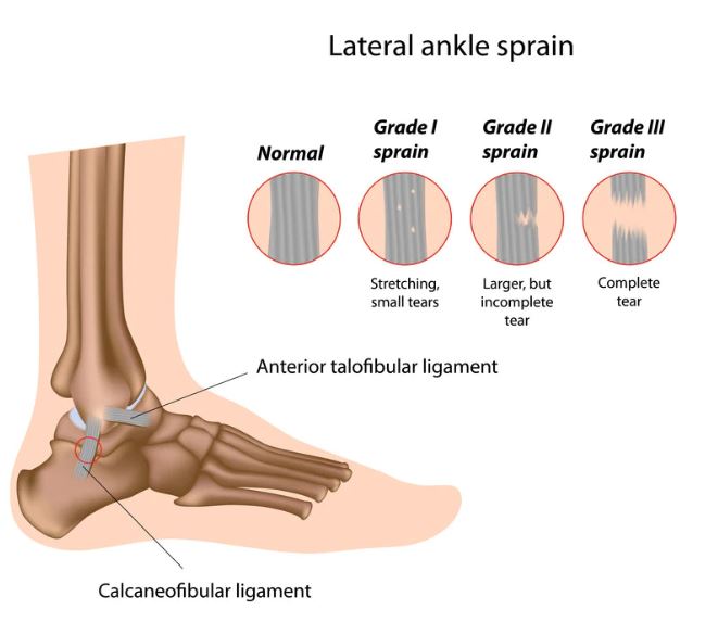 발목 염좌가 잘 일어나는 전거비인대와 인대 염좌의 단계를 나타내는 그림