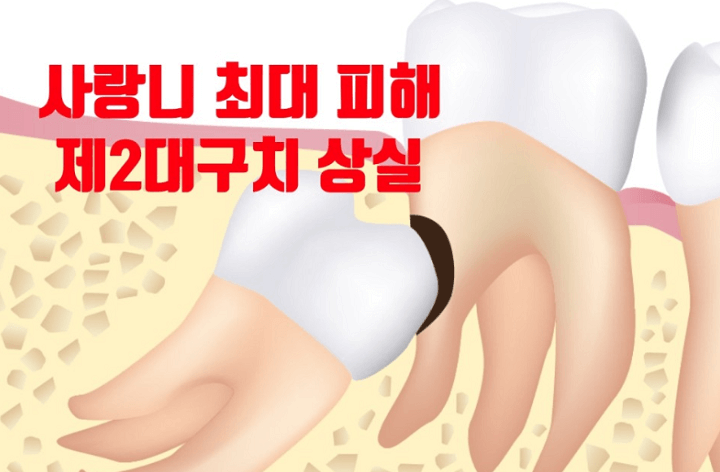 사랑니-옆-영구치-손실