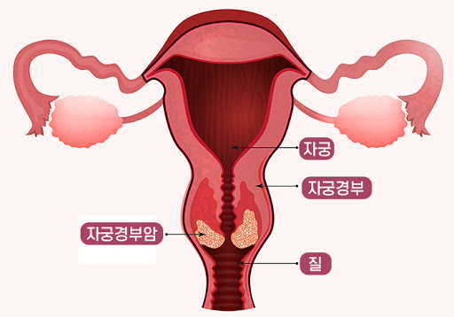  자궁경부암 증상 ,예방접종 가격, 검사 방법 총정리