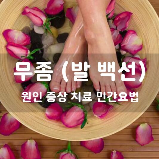  무좀(발 백선) 치료, 원인과 증상, 민간요법 총 정리!
