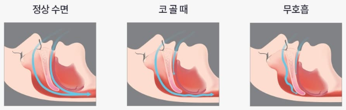 정상-수면과-코골이-수면무호흡