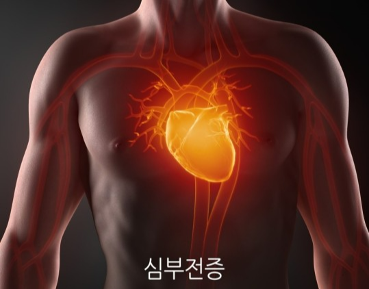  심혈관질환인 심부전증에 대해 알아보자!