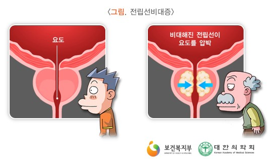 전립성 비대증