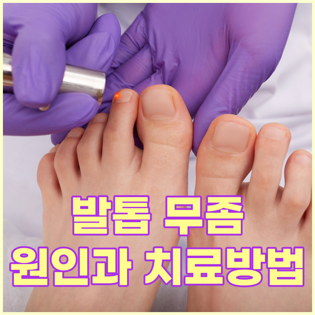발톱무좀을 치료하는 방법