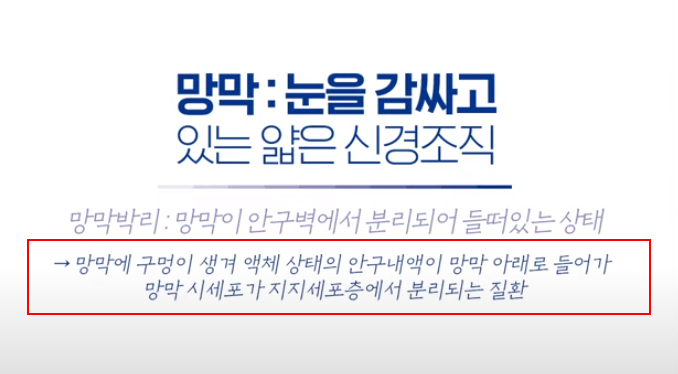 망막박리