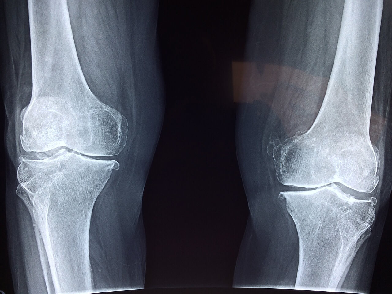 무릎 x-ray사진