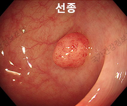  대장용종이란 무엇인가? 원인 예방 치료법 알아보기