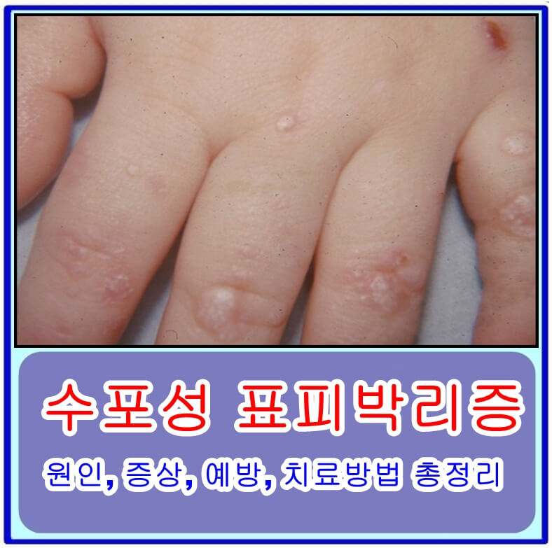  수포성 표피박리증의 원인, 증상, 예방, 치료방법 총정리