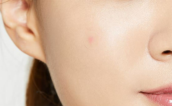 여드름(볼,턱)의 원인과 재발은 한의원 가세요 여드름(볼,턱)의 원인과 재발은 한의원 가세요