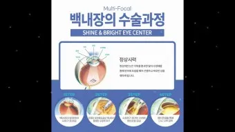 백내장 수술비용 가격 증상_14