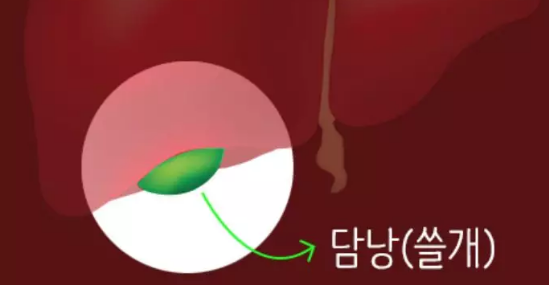  담석증 예방법