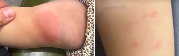 온몸에 빨갛게… 아이들까지 병원행 출처:해럴드경제