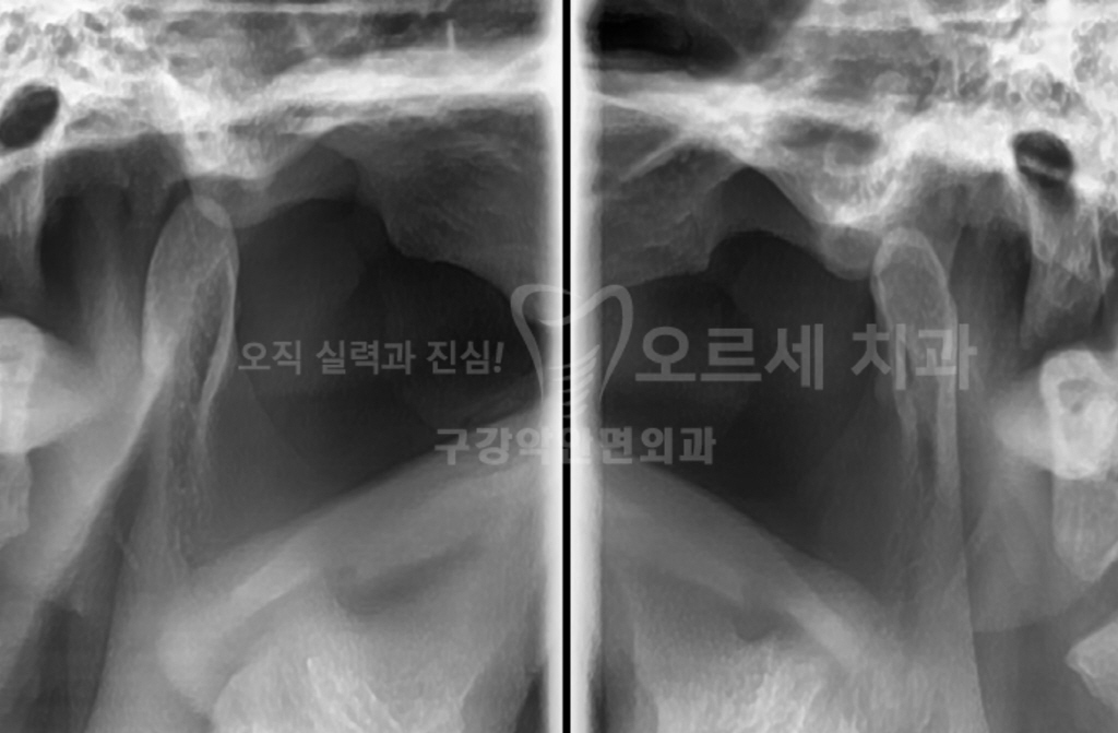 심한 턱 근육 통증과 입 벌릴 때 턱 걸림 생겼을 때 찾는 신논현역 치과