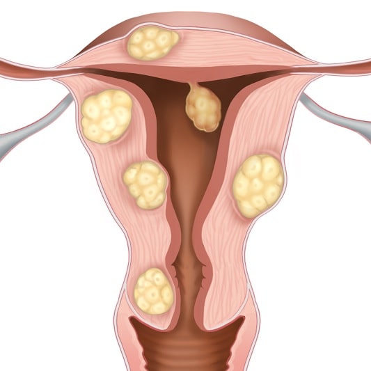자궁근종은 암이 아닌 자궁 근육 세포에 발생한 근종