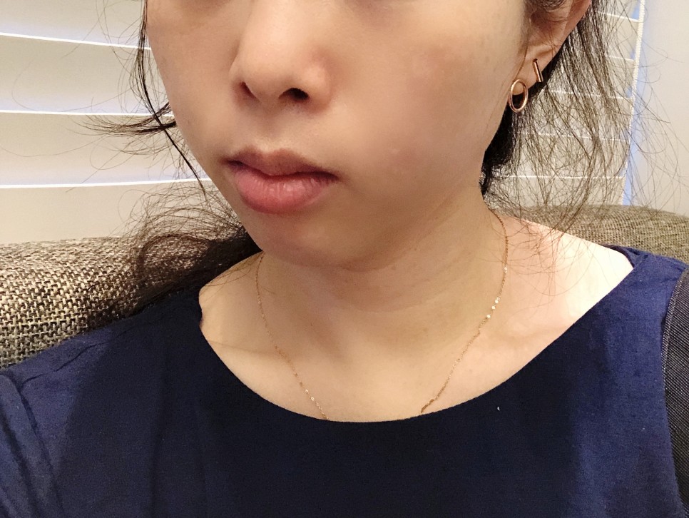 콧볼 축소 비용 [강남/보톡스] 콧볼축소주사-후기 9