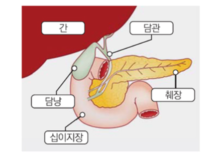 담석으로 인한 합병증