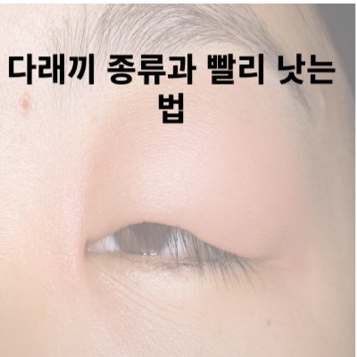 다래끼 종류와 빨리 낫는 법