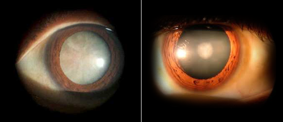 백내장 - 이미지