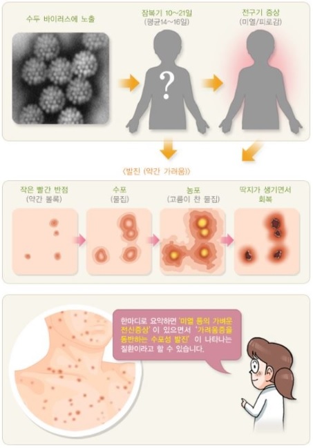 수두 증상