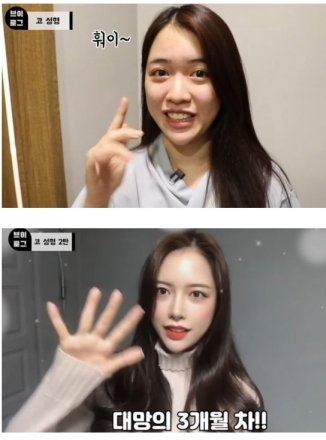  코 성형 후기