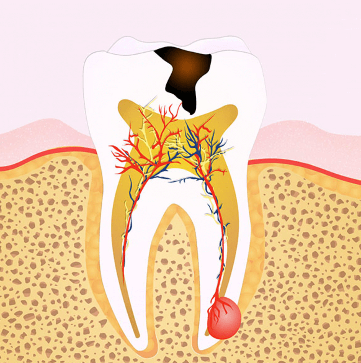 치아 염증