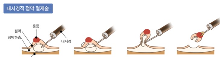 용종 제거술