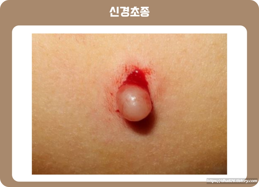 신경초종 사진