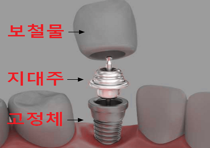 임플란트에 쓰이는 3가지 구성품 사진