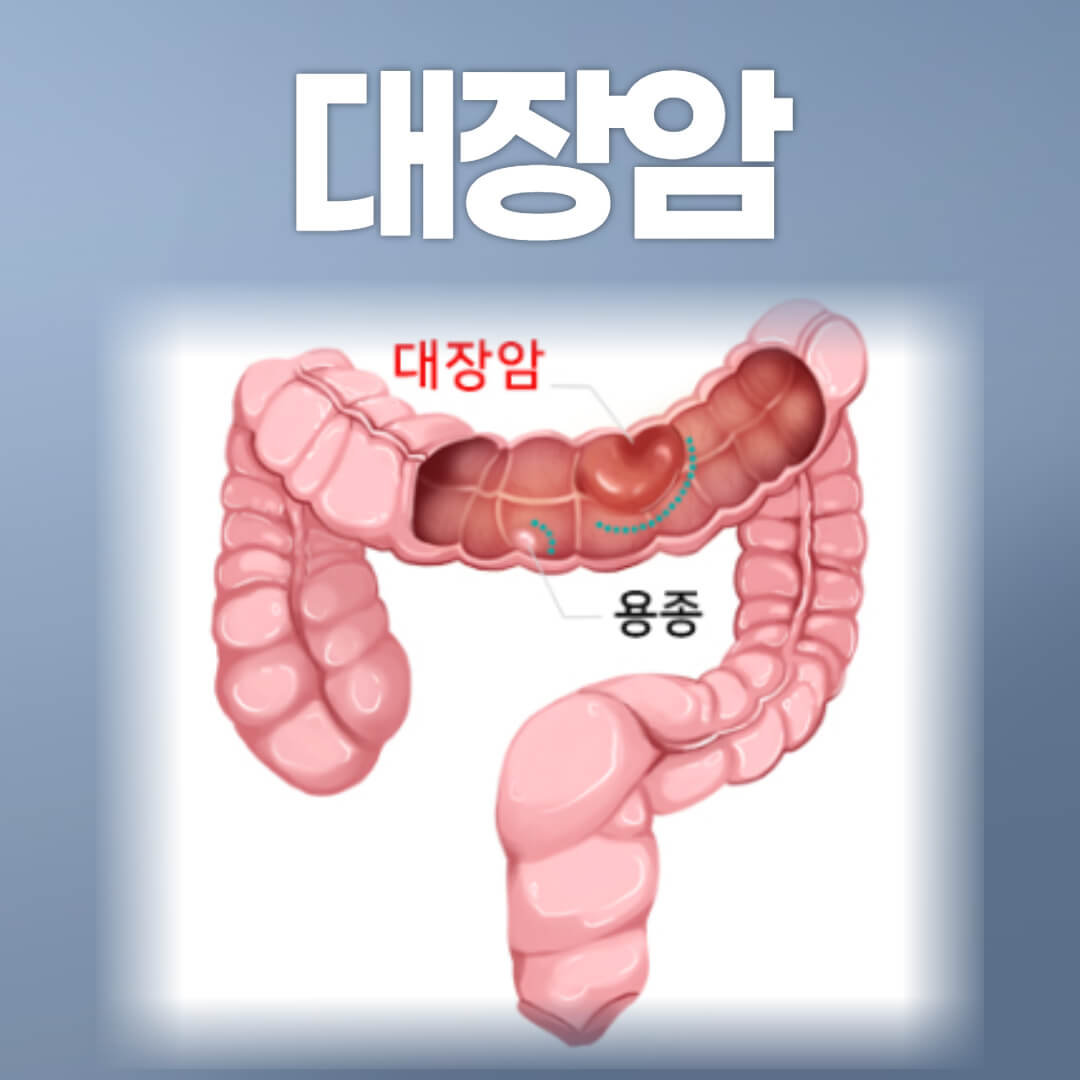 대장암