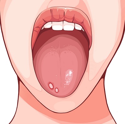 혀에 하얀 색 궤양이 발생했다