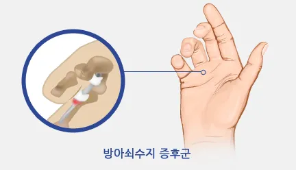 방아쇠 수지 증후군