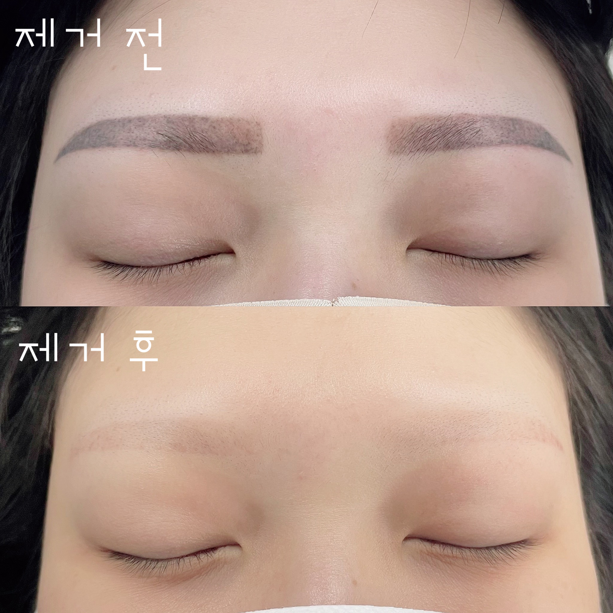  천안 눈썹문신, 잔흔지우기 ? 커버하기? 뭐가 더 좋을까요